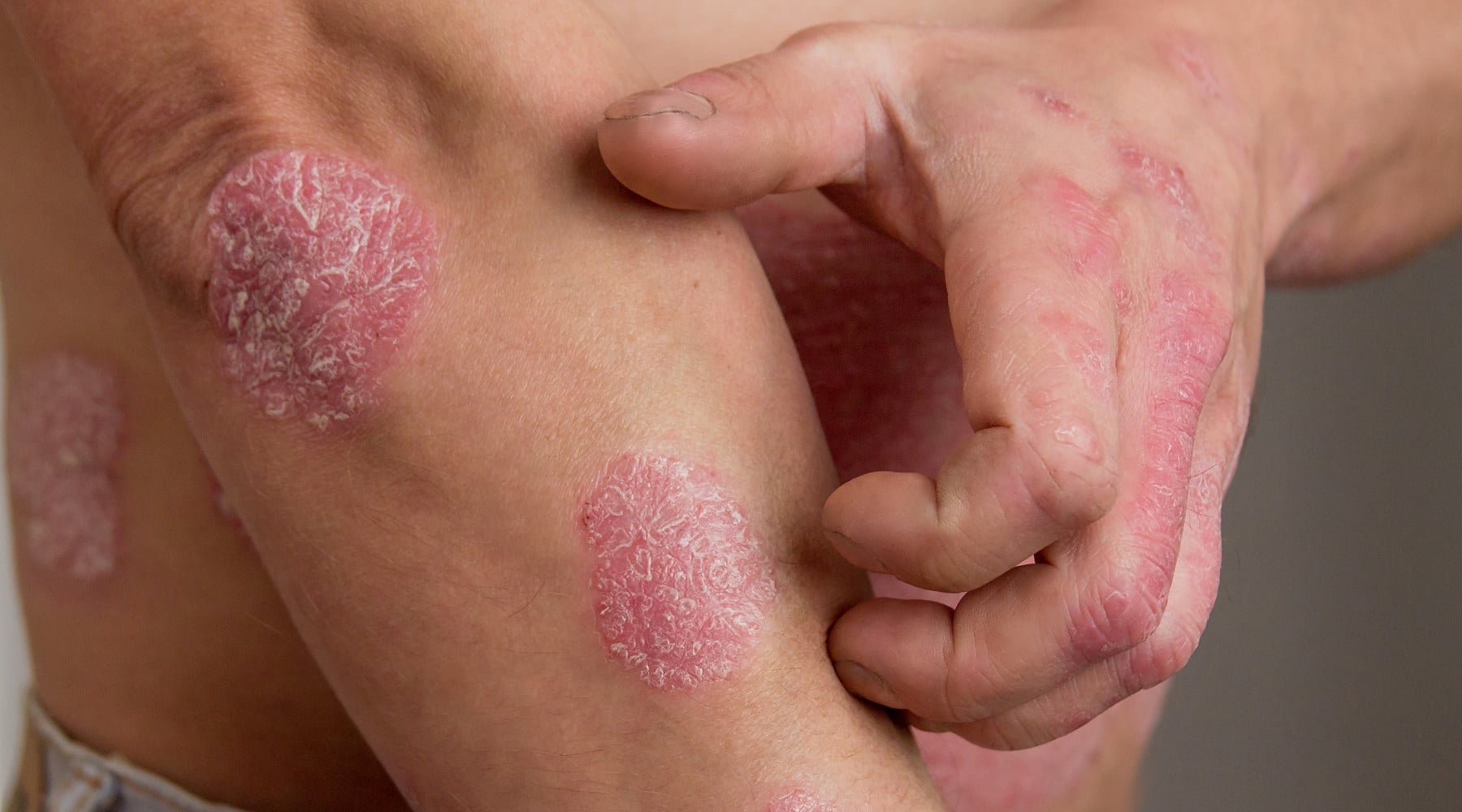 Let's Talk About Eczema - Naturally Mignon CBD