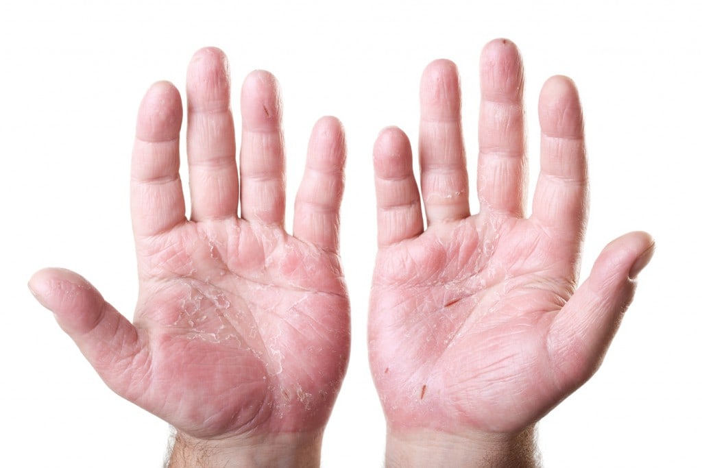 What is Hand Eczema? - Naturally Mignon CBD