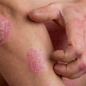 Let's Talk About Eczema - Naturally Mignon CBD